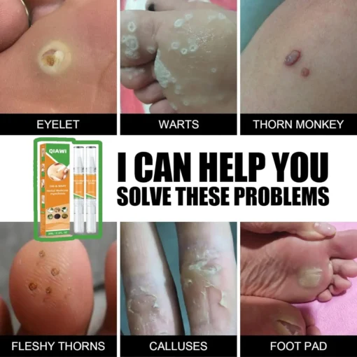 QIAWI™ Skin Tag & Mole Remover