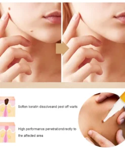 QIAWI™ Skin Tag & Mole Remover