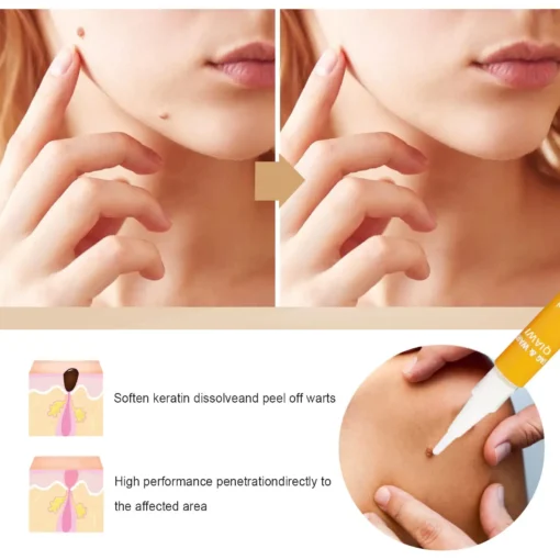 QIAWI™ Skin Tag & Mole Remover
