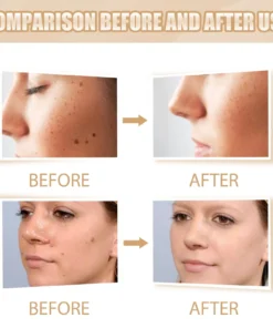 QIAWI™ Skin Tag & Mole Remover
