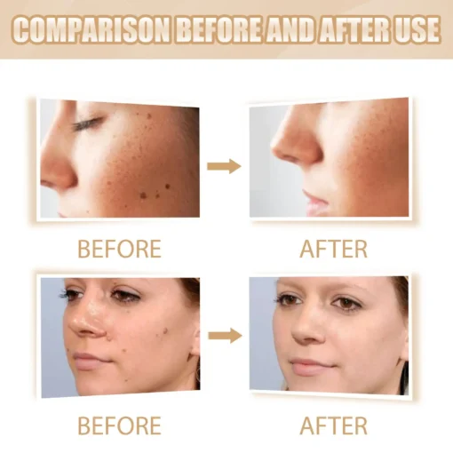 QIAWI™ Skin Tag & Mole Remover