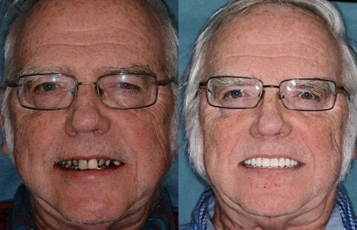 QIAWI™ Advanced Customized Full Denture Set - Image 2
