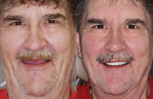 QIAWI™ Advanced Customized Full Denture Set - Image 3