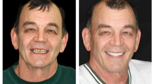 QIAWI™ Advanced Customized Full Denture Set - Image 4