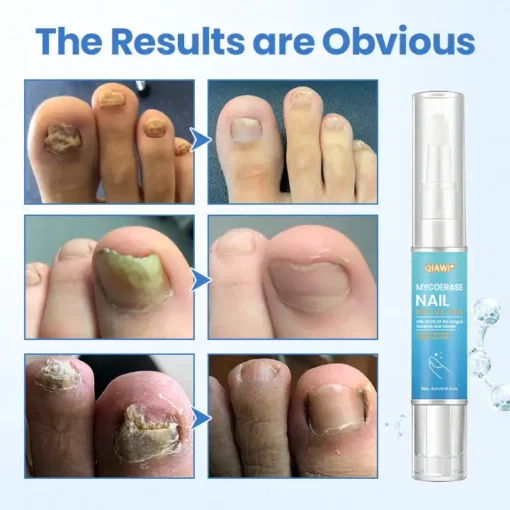 QIAWI® MycoErase Nail Revive Pen