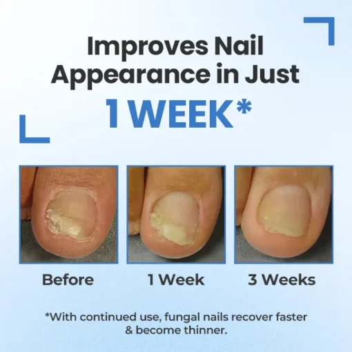 QIAWI® MycoErase Nail Revive Pen