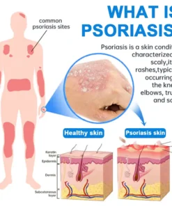 QIAWI Magnesium Herbal Psoriasis Spray