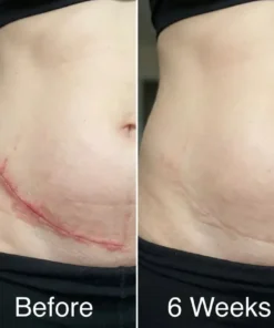 QIAWI Scar removal Silicone stick-Face & Body