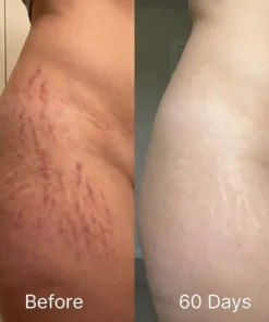 QIAWI Scar removal Silicone stick-Face & Body