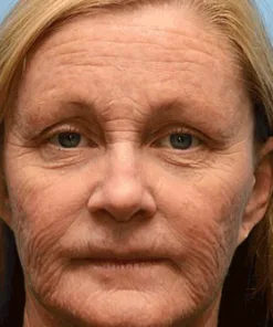 QIAWI™ Botulinum Vita-A Retinol Shot Wrinkle-Lift Tightening cream