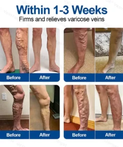 QIAWI™ VeinTarget Microneedle PatchInstant Relief, Long-Term Results