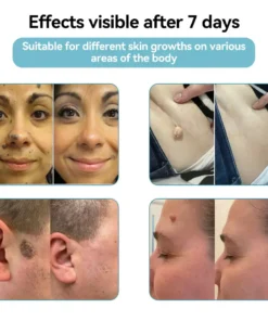 QIAWI™ All-in-One CO₂ Laser Eraser Pen Removes Moles, Warts, Skin Flaws Pigmentation