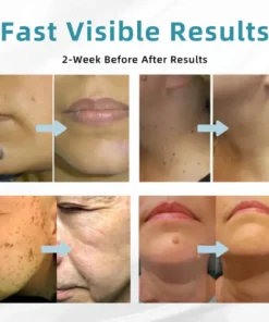 QIAWI™ All-in-One CO₂ Laser Eraser Pen Removes Moles, Warts, Skin Flaws Pigmentation