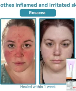 QIAWI™ All-in-One CO₂ Laser Eraser Pen Removes Moles, Warts, Skin Flaws Pigmentation