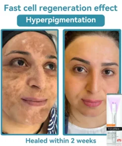 QIAWI™ All-in-One CO₂ Laser Eraser Pen Removes Moles, Warts, Skin Flaws Pigmentation