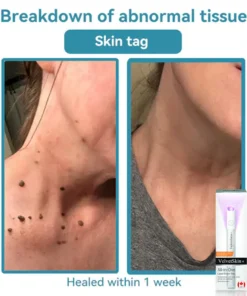 QIAWI™ All-in-One CO₂ Laser Eraser Pen Removes Moles, Warts, Skin Flaws Pigmentation