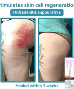 QIAWI™ All-in-One CO₂ Laser Eraser Pen Removes Moles, Warts, Skin Flaws Pigmentation